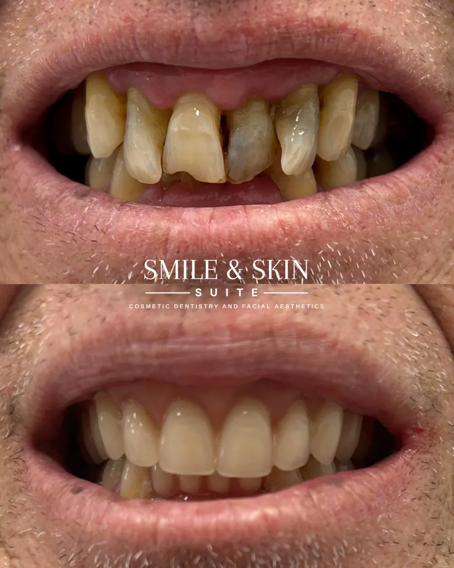 Results Before and After