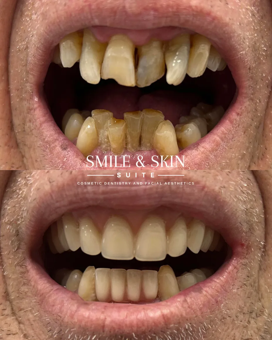 Results Before and After