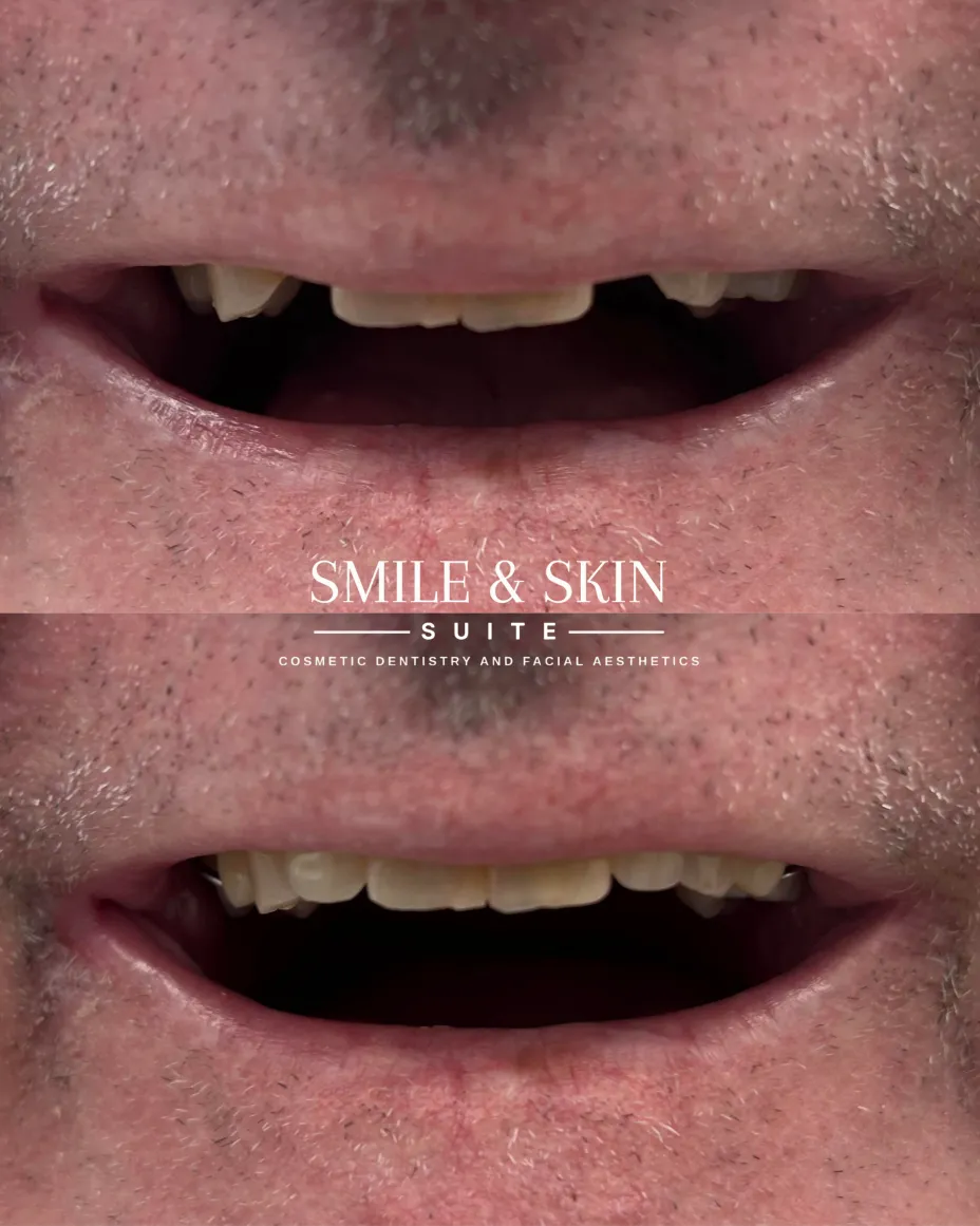 Results Before and After