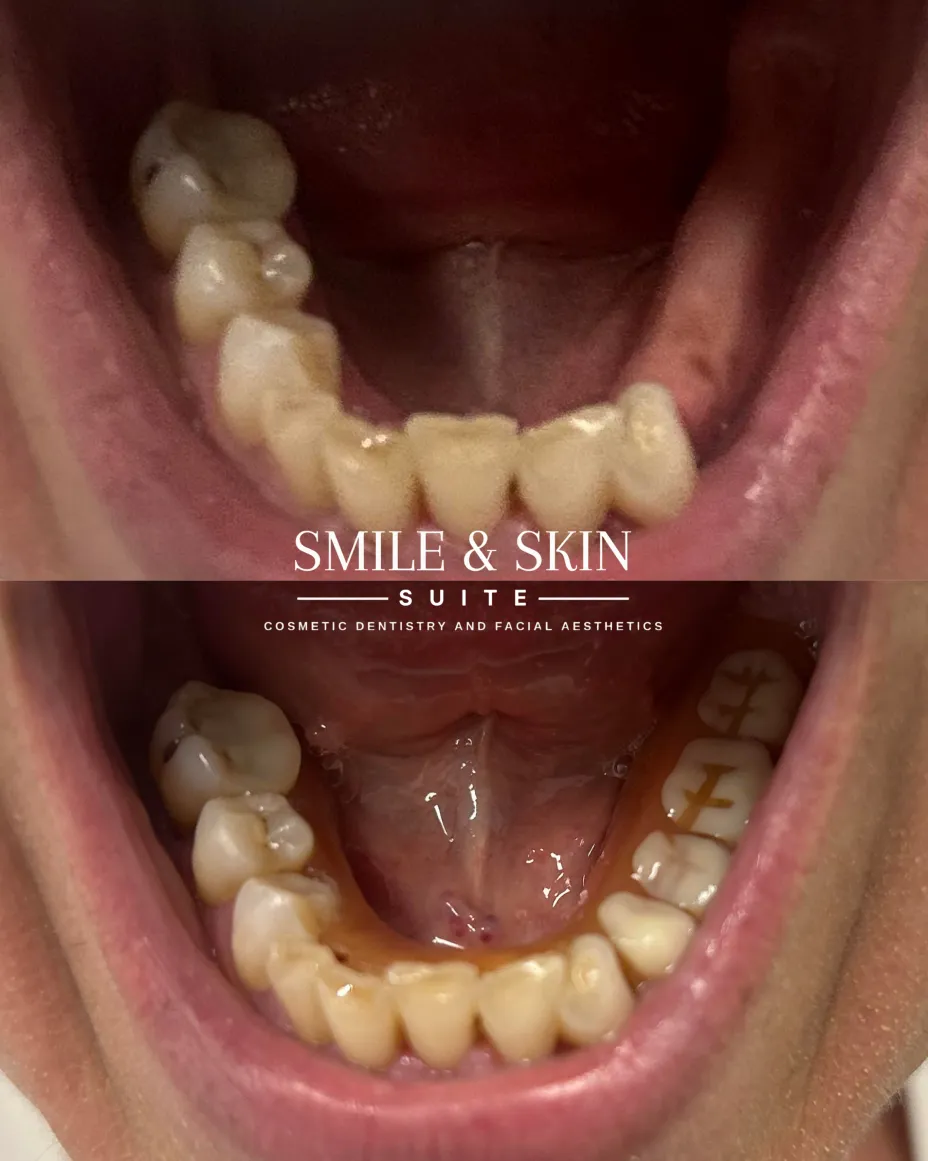 Results Before and After