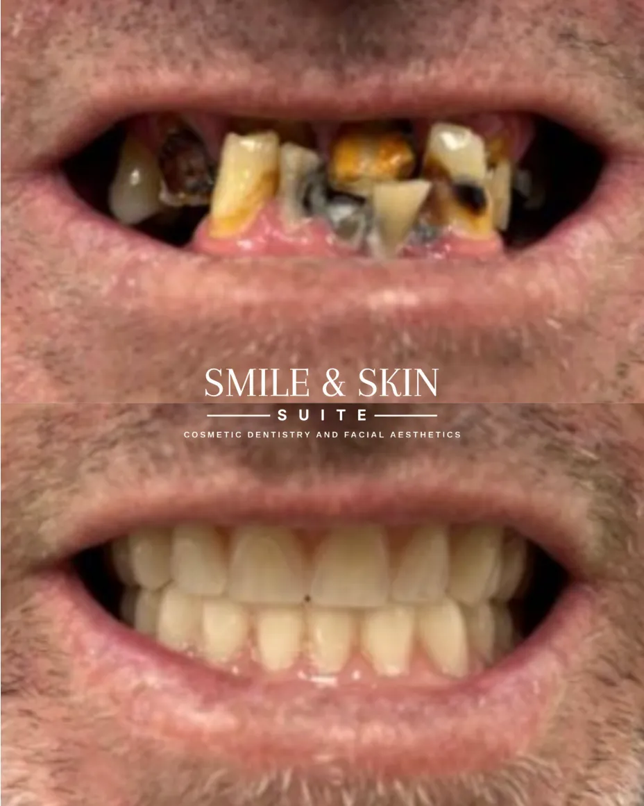 Results Before and After